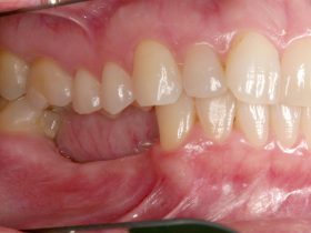 missing teeth